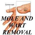 Mole and Wart Removal!