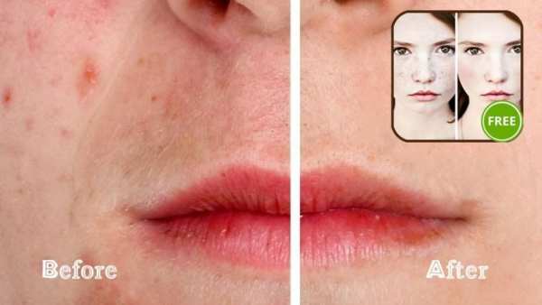 Blemish Remover screenshot 2