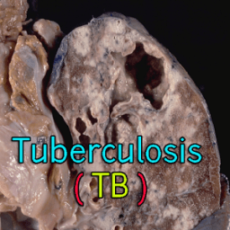 Tuberculosis TB आइकन