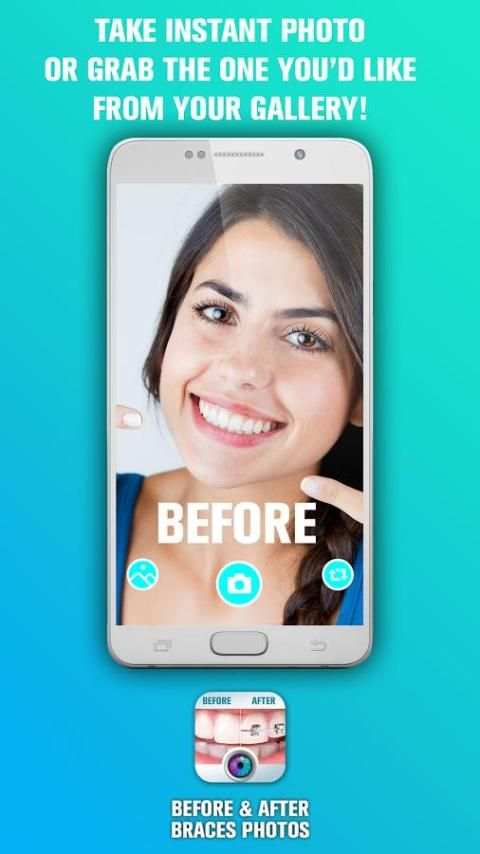 Before and After braces Photo screenshot 1