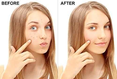 Pimple Remover screenshot 3