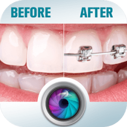 Before and After braces Photo иконка