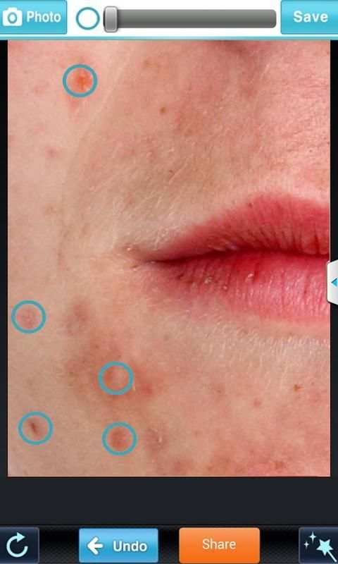 Blemish Remover screenshot 3
