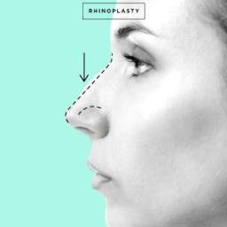 Rhinoplasty and Nose Job