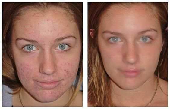 Pimple Remover screenshot 2