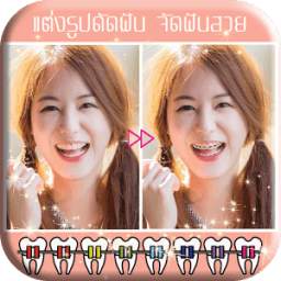 Braces 1.0