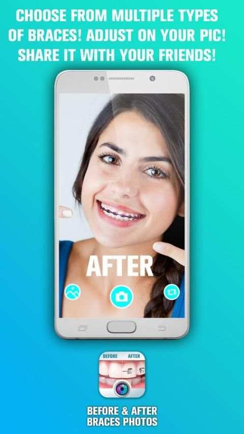 Before and After braces Photo screenshot 2