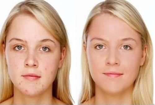 Pimple Remover screenshot 4