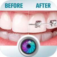 Before and After braces Photo