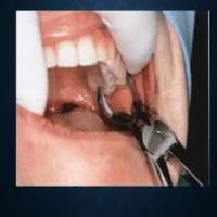 Exodoncia en Odontología on 9Apps