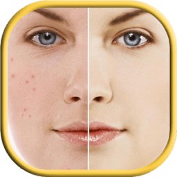 خلطات مجربة لإزالة حب الشباب icon