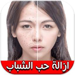 ازالة حب الشباب 1.0