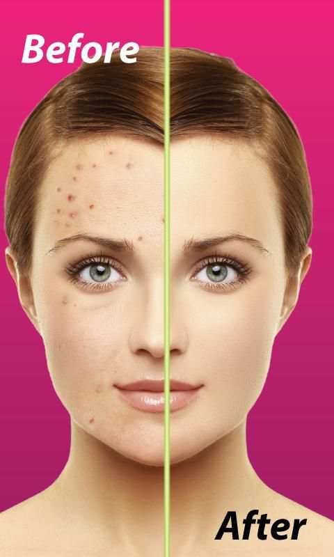 Pimple Remover screenshot 2