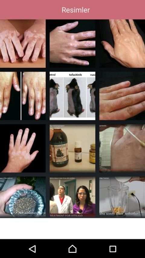 Vitiligo Türkiye скриншот 1