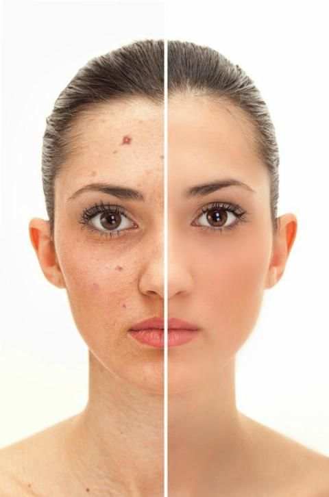 Acne Remover Photo Editor screenshot 3