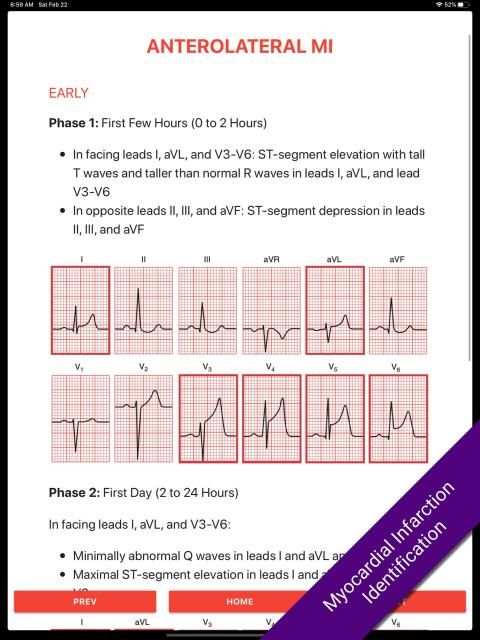 ECG FlashCards 2 Lite - Free Reference EKG App screenshot 2