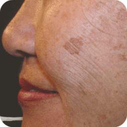 Age Spot Removal Home Remedy