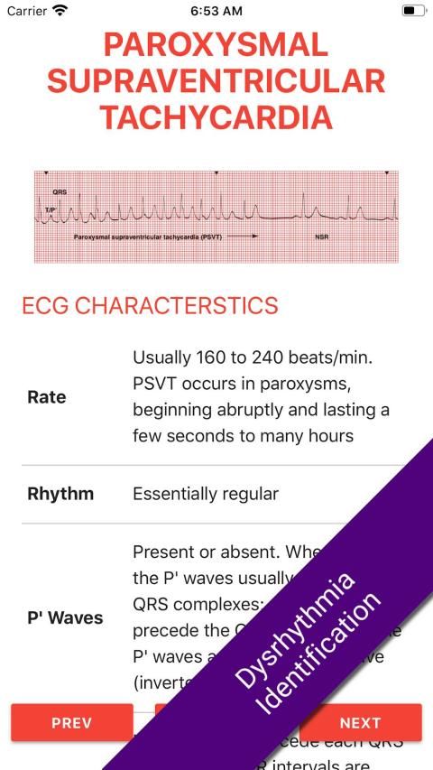 ECG FlashCards 2 Lite - Free Reference EKG App स्क्रीनशॉट 11