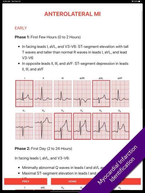ECG FlashCards 2 Lite - Free Reference EKG App स्क्रीनशॉट 2