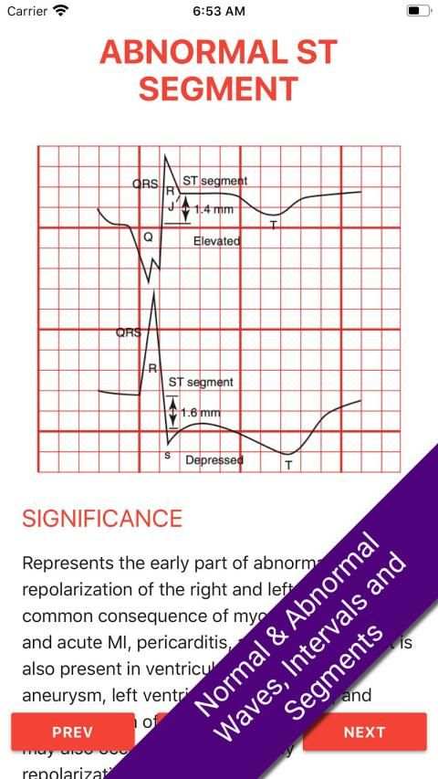 ECG FlashCards 2 Lite - Free Reference EKG App screenshot 12