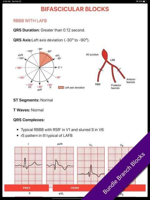 ECG FlashCards 2 Lite - Free Reference EKG App screenshot 3