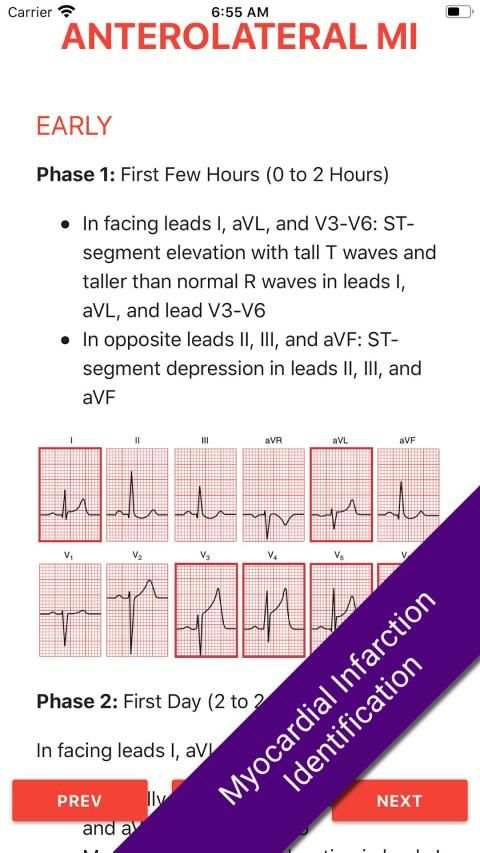 ECG FlashCards 2 Lite - Free Reference EKG App screenshot 8
