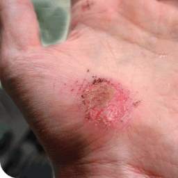 Abrasions Home Remedies