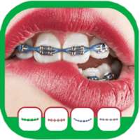 Braces Editor