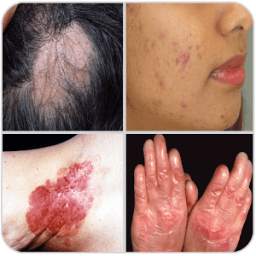 All Skin Diseases and Treatments- A to Z