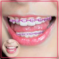 Braces – Selfie Camera