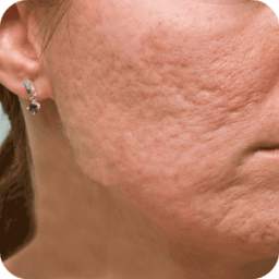 Acne Scar Removal Home Remedy