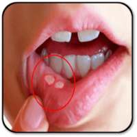 Remove a Mouth Ulcer