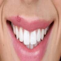 Cold Sores Treatment on 9Apps