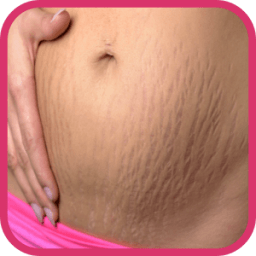 How to remove stretch marks icon