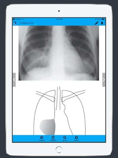 CXR FlashCards - Reference app for Chest X-rays screenshot 2