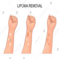 Lipoma Solution Disease