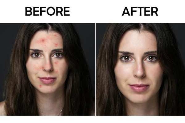 Acne Remover Zit remover Pimple Eraser 5 تصوير الشاشة