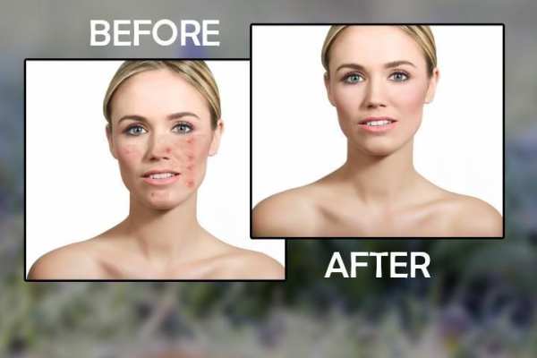 Acne Remover Zit remover Pimple Eraser 3 تصوير الشاشة