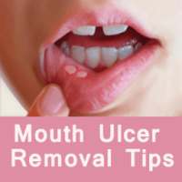 Mouth Ulcer Removal Tips - मुँह के छाले मिटाये on 9Apps