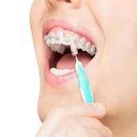 Braces Cleaning Tips