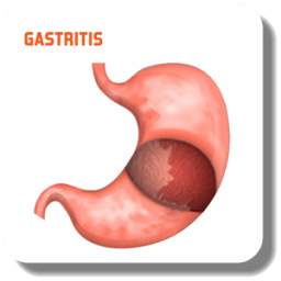 Treat Gastritis