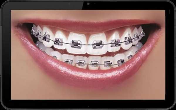 Real Braces teeth Selfie Camer screenshot 2