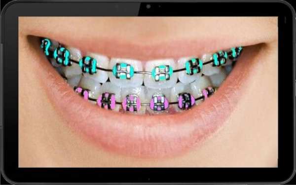 Real Braces teeth Selfie Camer screenshot 1