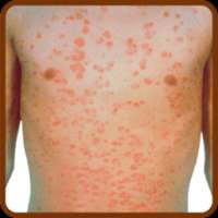 Psoriasis Natural Treatment Guide