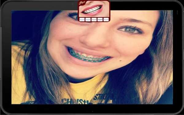 Top Disegn Braces Teeth Camera स्क्रीनशॉट 1