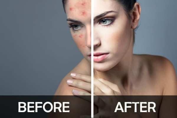 Acne Remover Zit remover Pimple Eraser 1 تصوير الشاشة