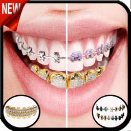 Gold and braces Teeth 2.0