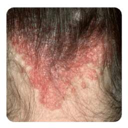 scalp psoriasis