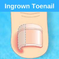 Ingrown Toenail on 9Apps