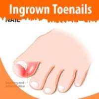 Ingrown Toenails‏‎